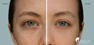 Résultat avant après d'une femme ayant réalisée un soin hydrafacial