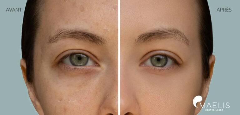 Résultat avant après d'une femme ayant réalisée un soin hydrafacial