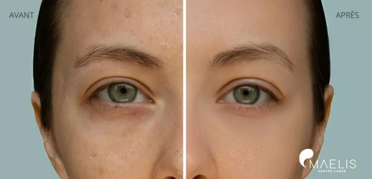 Résultat avant après d'une femme ayant réalisée un soin hydrafacial