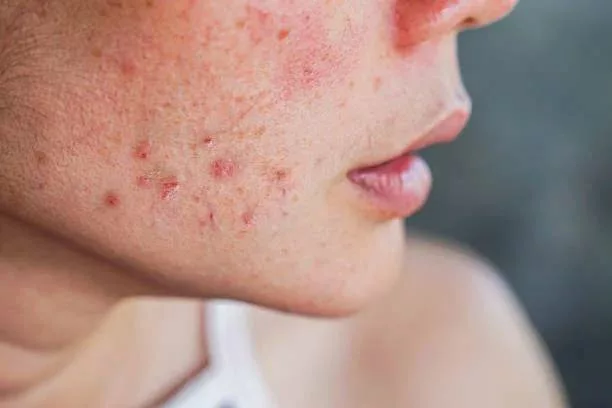 Visage d'une femme ayant de l'acné