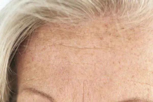 Ridule sur le front d'une femme