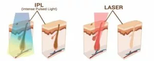 Reconstitution visuel de la différence de technique d'élimination du poil entre l'IPL et du Laser