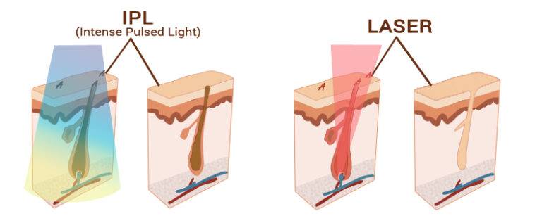 Reconstitution visuel de la différence de technique d'élimination du poil entre l'IPL et du Laser