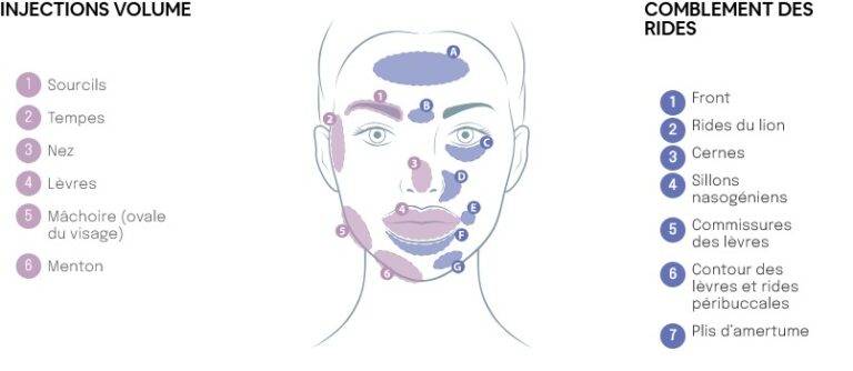 Zones d’injection d’acide hyaluronique réalisé chez Maelis centre laser pour le comblement des rides du visage et la restauration des volumes : front, sillons nasogéniens, cernes, lèvres, menton, mâchoire
