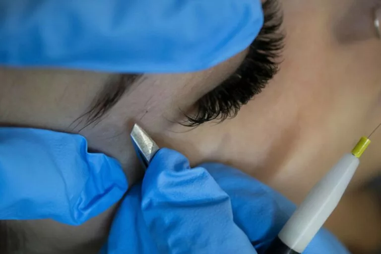 Épilation électrolyse des sourcils d'une femme réalisée par une esthéticienne Maelis centre laser